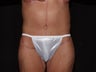 Body Lift