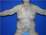 Body Lift