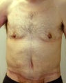 Bodylift & removal of excess chest skin