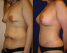 Lower Body lift, Breast Augmentation