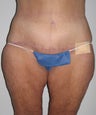 Body lift, tummy tuck, liposuction