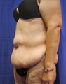 Circumferential Body Lift