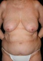 Body Lift