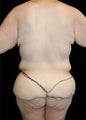 Body Lift