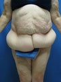 Circumferential Body Lift