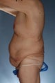 Body Lift After Weight Loss