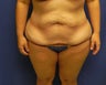 Body Lift