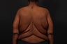 Bra Line Back Lift