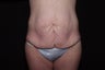 Body Lift