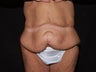 Body Lift