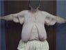 Body Lift