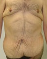 Bodylift & removal of excess chest skin