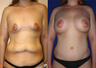 Lower Body lift, Breast Augmentation