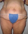 Body lift, tummy tuck, liposuction
