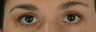 Botox