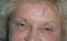 Crowsfeet treated with Botox Cosmetic