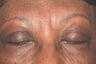 Botox for frown lines