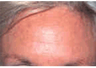 Botox