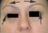 Botox Brow Lift