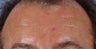 Botox to forehead