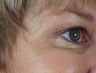 Botox to the crow's feet