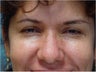 Botox Crow's feet