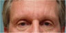 Botox frown lines