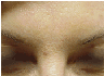 Botox