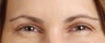 Botox Results