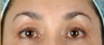 BOTOX