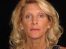 Botox and Restylane