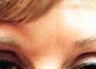 Botox