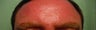 BOTOX in the forehead