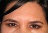Botox