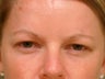 Botox Cosmetic