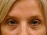 Botox Cosmetic