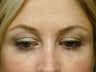 Botox Cosmetic