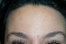 Botox Forehead
