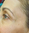 Botox for crow's feet