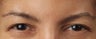 Botox