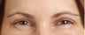 Botox