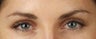 Botox