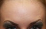 Botox