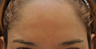 Botox to forehead and glabella