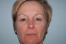 IPL Limelight Laser treatment, Pearl Laser Treatment and Botox