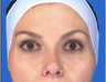 Botox Frontalis