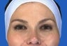 Botox Crow's Feet