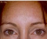 Botox