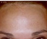 Botox
