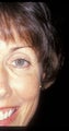 Botox